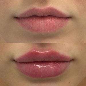 Anti durée 2ml non chirurgicale de remplisseur d'augmentation de lèvre de ride longue