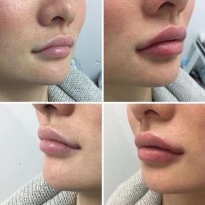 Injections cosmétiques de lèvre de gel liquide de remplisseur d'augmentation de lèvre de sécurité de beauté