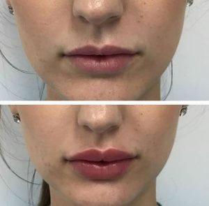 Injections cosmétiques de lèvre de gel liquide de remplisseur d'augmentation de lèvre de sécurité de beauté
